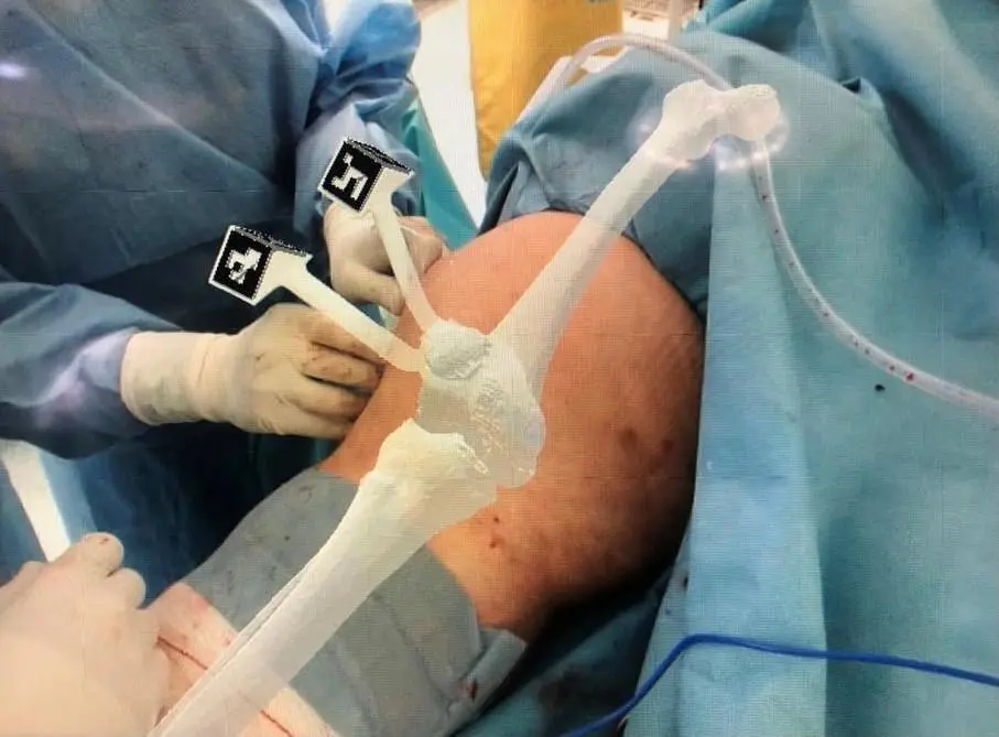 La cirug&iacute;a de rodilla realizada. - Quironsalud