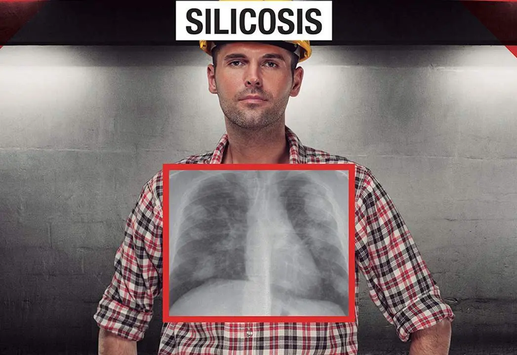 Silicosis. - 