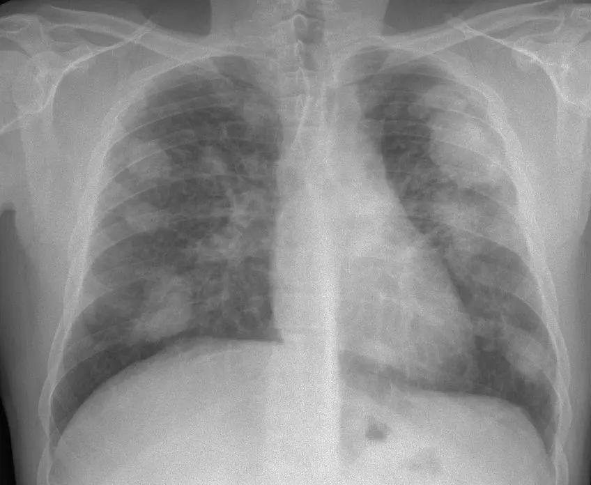 Un caso de silicosis complicada. - Wikimedia Commons