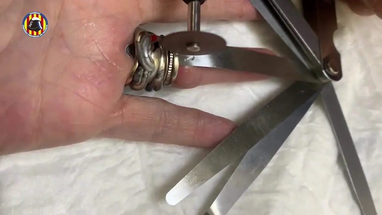Retiran 6 anillos que aprisionaban el dedo anular de una mujer