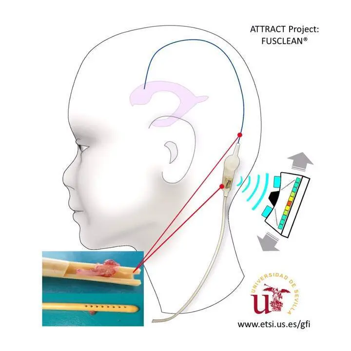 Desarrollan una nueva tecnolog&iacute;a para prevenir obstrucciones en cat&eacute;teres de pacientes con hidrocefalia - VM
