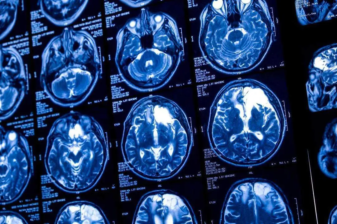 Foto de Epilepsia-Angelini Pharma. - 