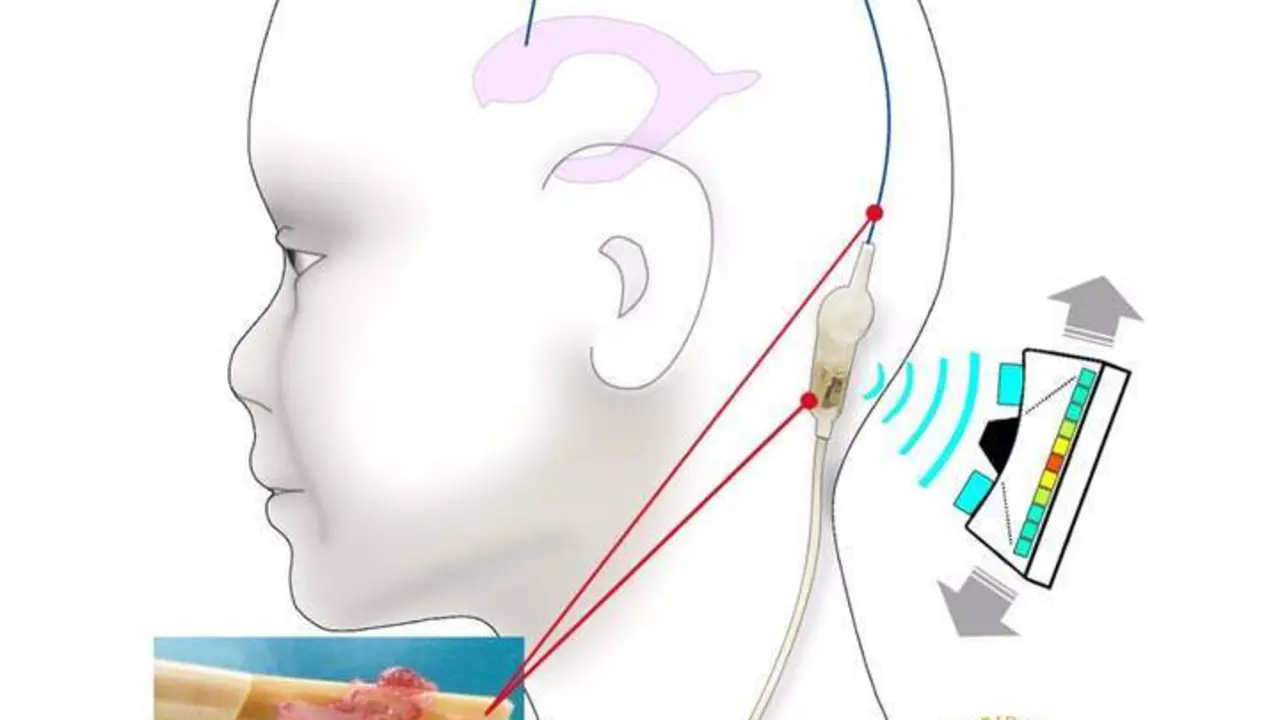 Desarrollan una nueva tecnolog&iacute;a para prevenir obstrucciones en cat&eacute;teres de pacientes con hidrocefalia - VM