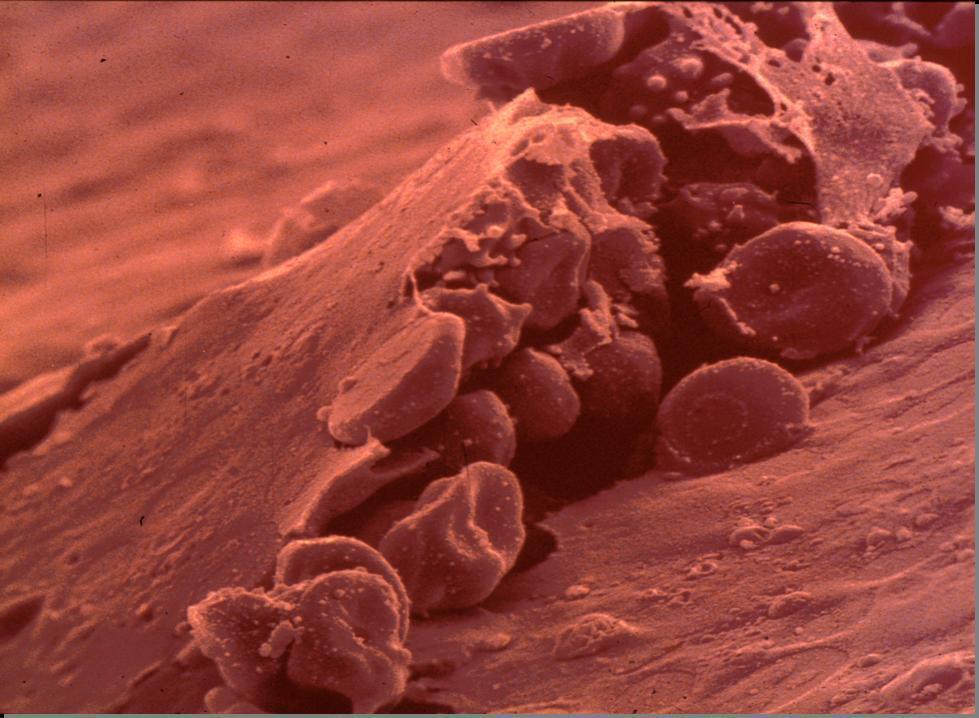 Placa de ateroma levantada peligrosamente en una arteria coronaria, donde se observa un importante conglomerado de cÃ©lulas sanguÃ­neas tratando de reparar el defecto.